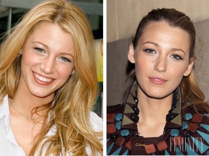 Aj Blake Lively má za sebou plastiku nosa