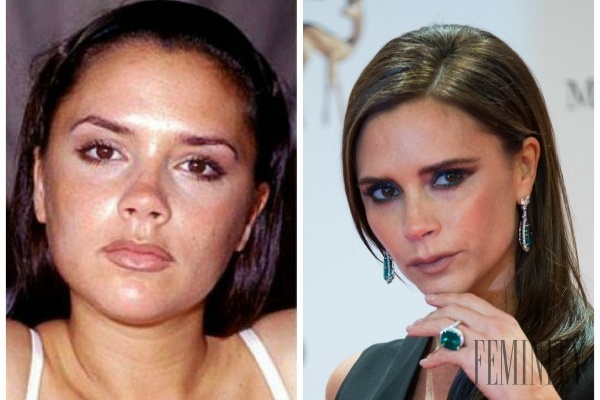 Victoria Beckham si nechala okrem poprsia upraviť aj nos