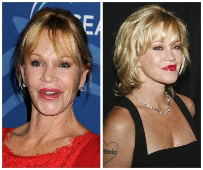 Tvár Melanie Griffith je tiež poznačená plastikami